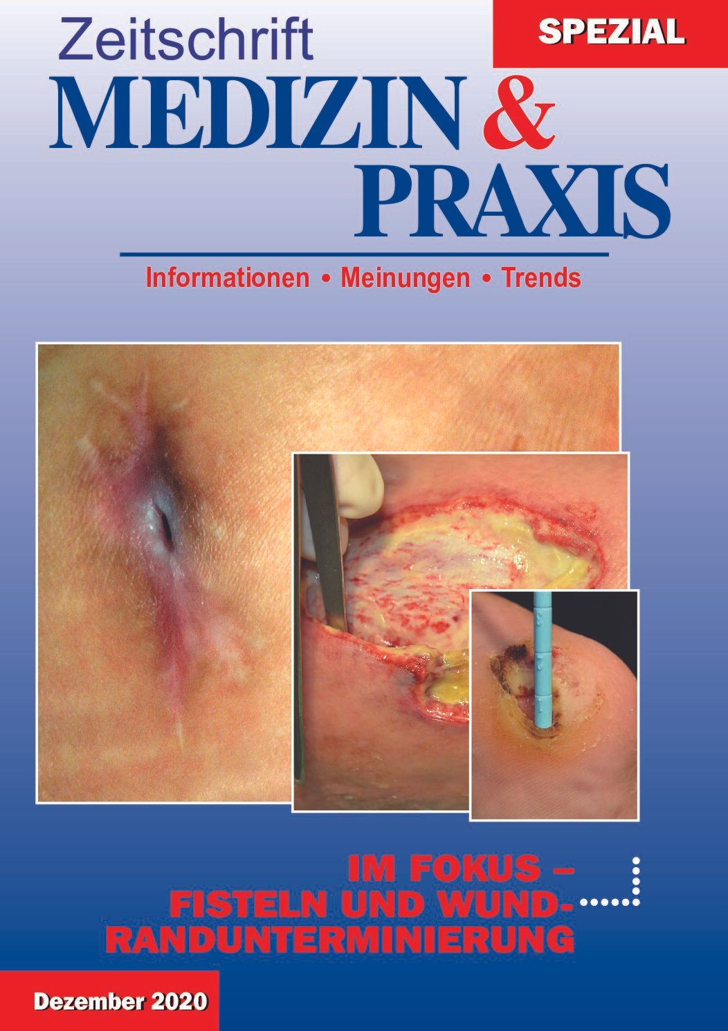 Fisteln und Wundrandunterminierung - 2020