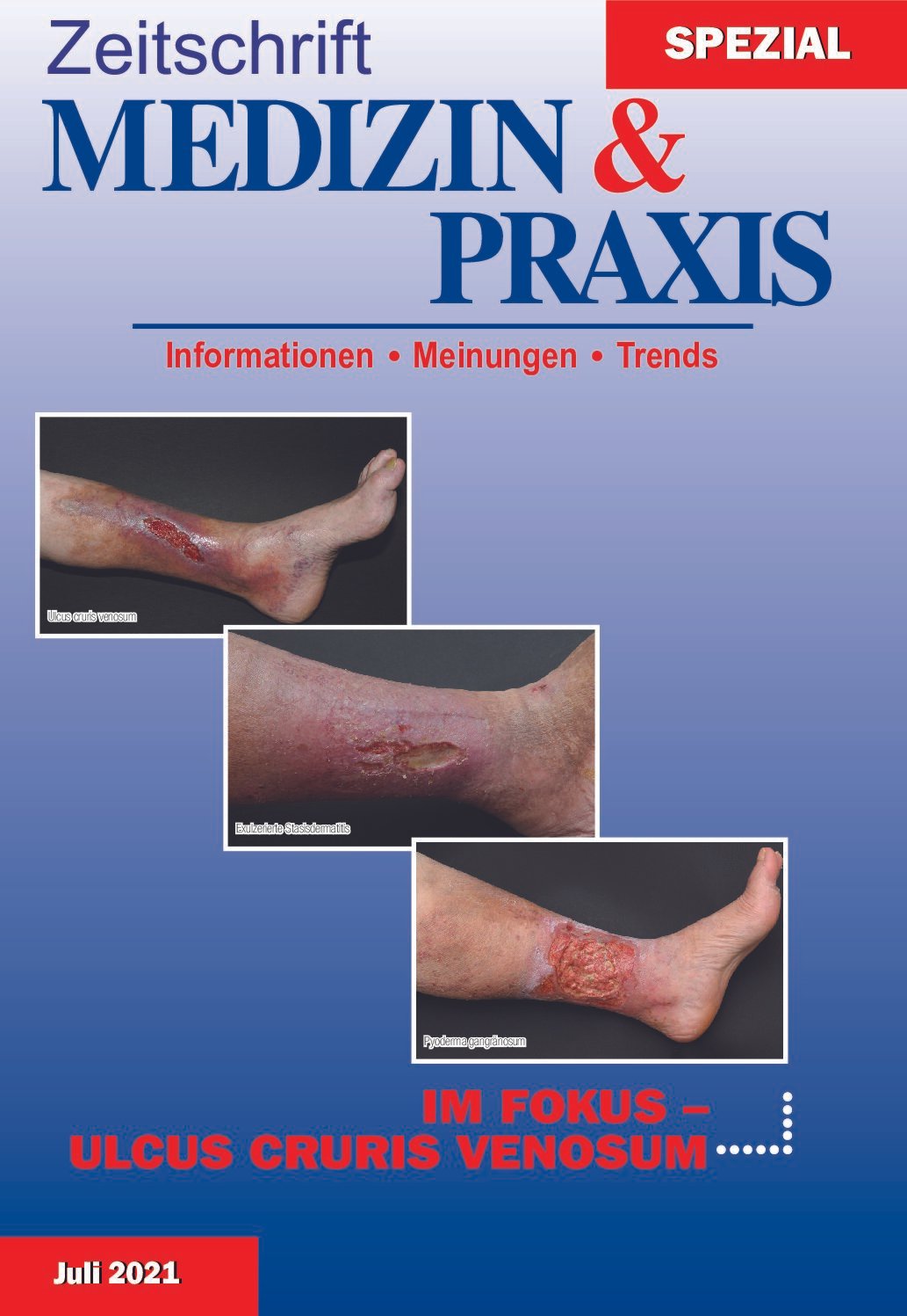 Ulcus cruris venosum - 2021